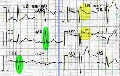 Brugada ECG Brugada